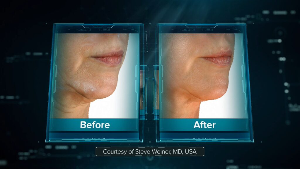 Lutronic_Genius_product video_Online.mp4_snapshot_01.53 Applicateurs Coolsculpting - Bordeaux - cryolipolyse