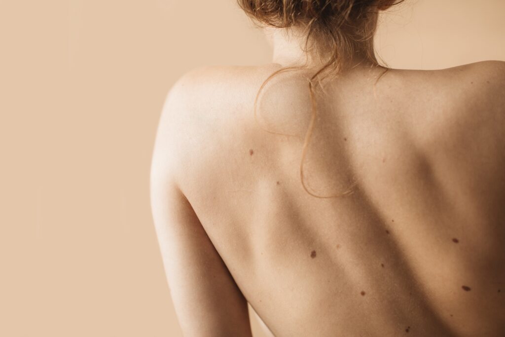 Woman body tache cutanée, dermatologue spécialiste taches pigmentation paris, taches sur la peau, tâches pigmentaires traitement